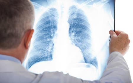 Arzt schaut auf Röntgenbild einer Lunge